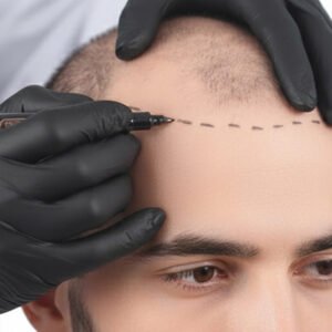 MICROPIGMENTATION. Sainte-Maxime