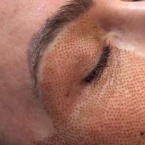 Microneedling - Plasma Pen Sainte-Maxime