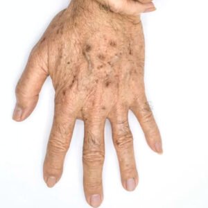 Traitement taches brunes sainte-maxime